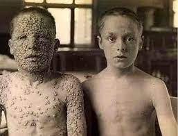 La Vérette à l'Île de La Réunion : Histoire d'une Épidémie Dévastatrice